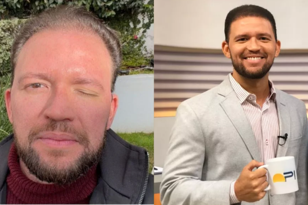 Apresentador famoso aplica botox e exibe complicações após procedimento